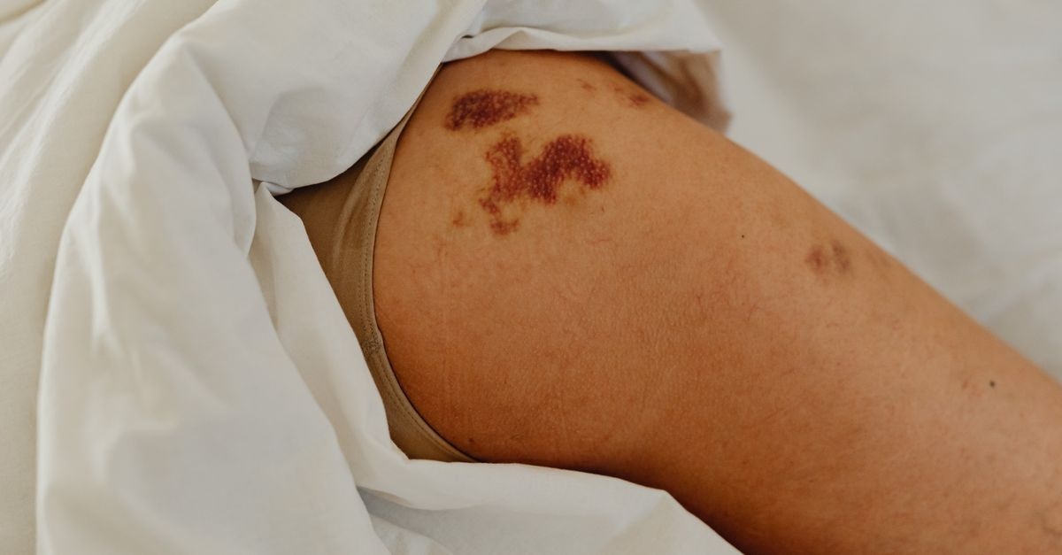 Wenn der Körper Alarm schlägt: Wichtige Thrombose-Anzeichen bei Frauen früh erkennen